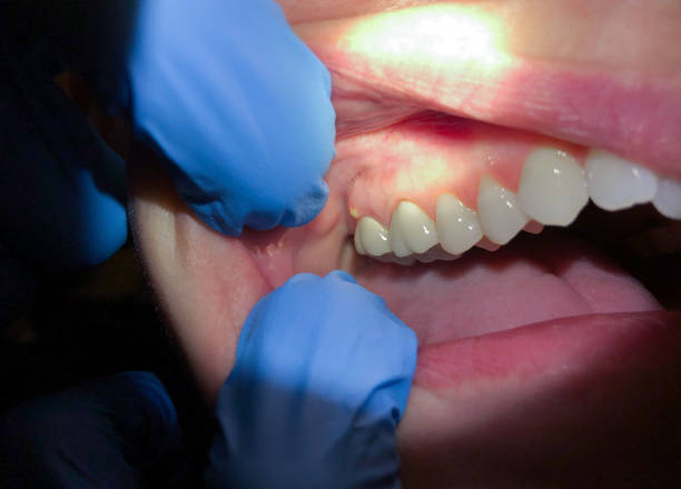 Best Knocked-Out Tooth (Avulsed Tooth) Treatment in Rogersville, TN